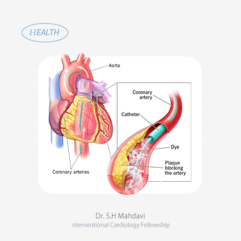 آنژیوگرافی چجوری انجام میشه